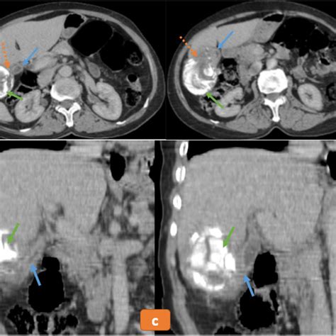 Abdominal Ct Scan Enhanced At Portal Time In Axial Section A And B
