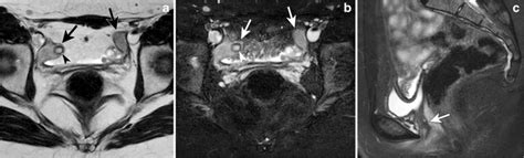 Mayer Rokitansky Küster Hauser Syndrome In A 16 Year Old Girl With Download Scientific Diagram