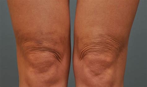 How To Treat Crepey Skin On Legs Prevageskin