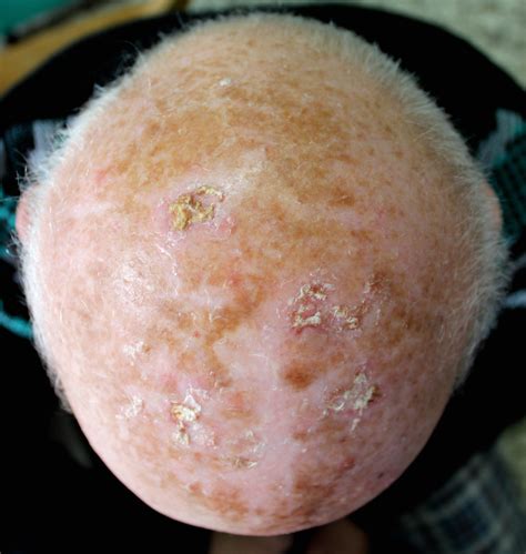Can Scabs On Your Scalp Be Cancer Scary Symptoms