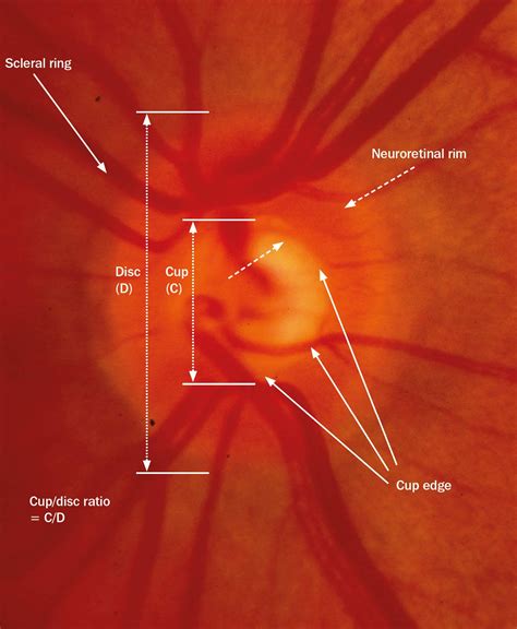 Opticdisc Community Eye Health Journal The Optic Nerve Head In