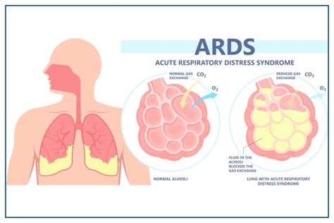 What Is Acute Respiratory Distress Syndrome ARDS Medicover