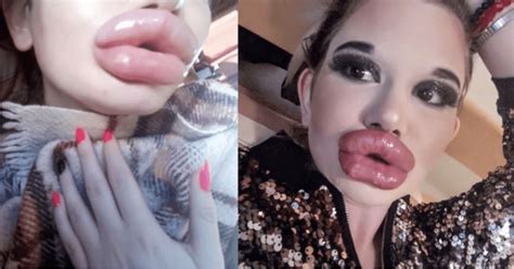Real Life Barbie Gets Her Th Lip Filler Injection To Achieve The