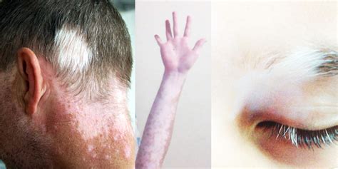 Symptoms Of Vitiligo Healthtopia