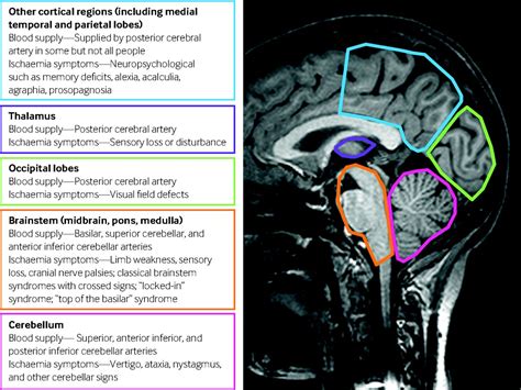 Posterior Circulation Ischaemic Stroke The Bmj