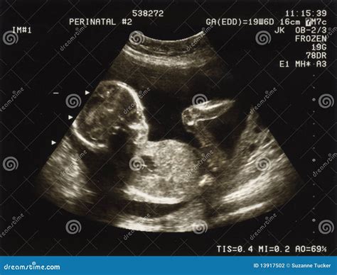 20 Weeks Pregnant With Twins Ultrasound