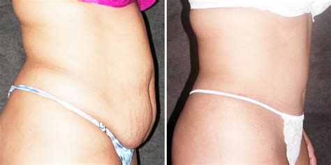 Before And After Abdominoplasty 07 Gallery Los Angeles CA Kao