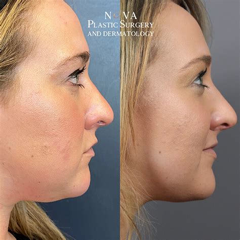 Kybella Injections And Double Chin Fat Reduction Treatments