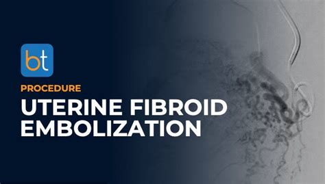 Uterine Fibroid Embolization Ufe Procedure Backtable Vi