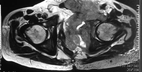 Mri Pelvis Showing T1 Hypointense And T2 Stir Mixed Signal Intensity