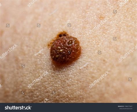 Skin Disease Closeup Brown Mole On Stock Photo 1788277607 Shutterstock