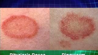 Nummular Eczema Vs Ringworm Whats The Difference My Xxx Hot Girl