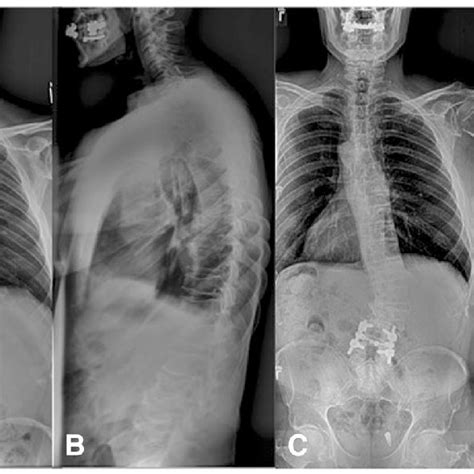 Anteroposterior Ap A And Lateral B Full Length Spine Radiographs