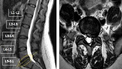 How i herniated a disc in my back and what i am doing to cope and recover. (Left) Sagittal view of a lumbar MRI showing an L5- S1 disc herniation... | Download Scientific ...