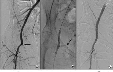 Figure 1 From Combined Open Surgical And Endovascular Management Of