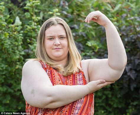 Woman With Giant Arms And Legs Pleas For K Daily Mail Online