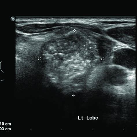 Ultrasound Of Thyroid Showing Left Thyroid Nodule Tr 5 Download