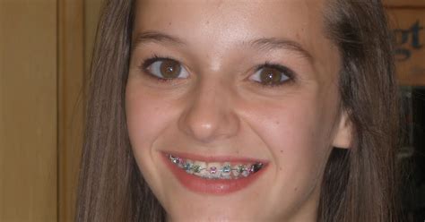 Braces For Two Brace Face Hot Sex Picture