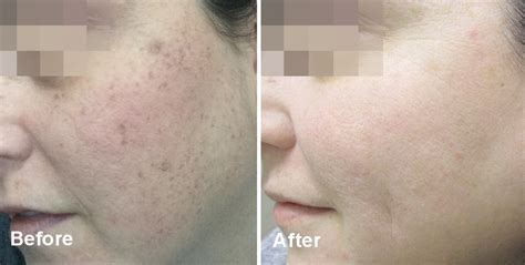 Lumecca Light Therapy Skin Resurfacing Treatments St