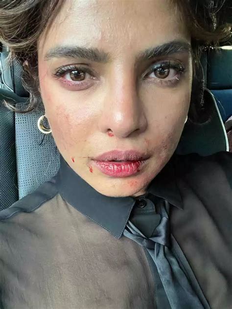 Priyanka Chopra Jonas Shares A Photo Of Her Bruised Face From The Set Of Citadel
