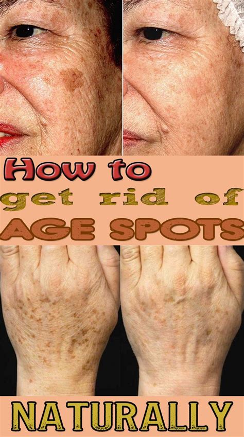 How To Get Rid Of Age Spots Naturally Age Spots