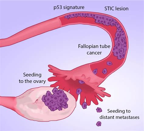 Scientists Track Ovarian Cancers To Site Of Origin Fallopian Tubes Globeathon