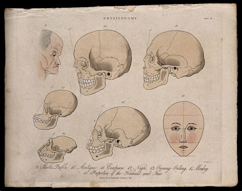 A Profile Of An Old Mentally Disabled Man Skulls Of Various Races Skulls Of A Monkey And An