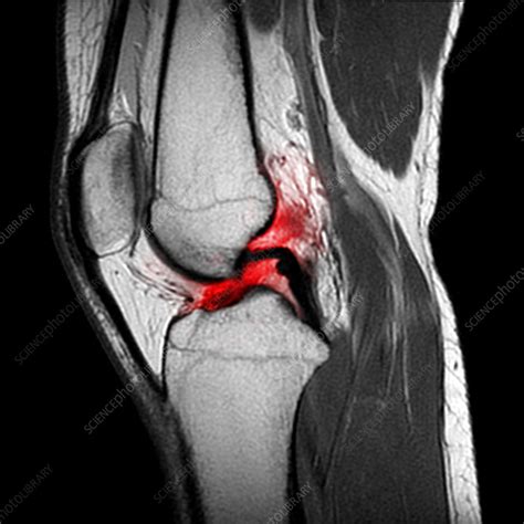Torn Acl Mri Stock Image C0305927 Science Photo Library