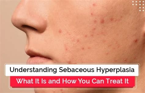 Understanding Sebaceous Hyperplasia Causes And Treatment Ws Dermatology
