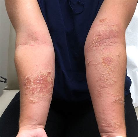Allergic Contact Dermatitis Pennsylvania Dermatology Specialists
