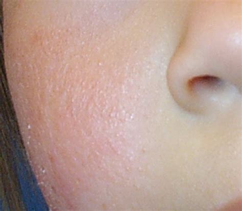 Mild Form Of Eczema Dorothee Padraig South West Skin Health Care