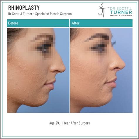 Rhinoplasty Before And After Photos Dr Scott Turner