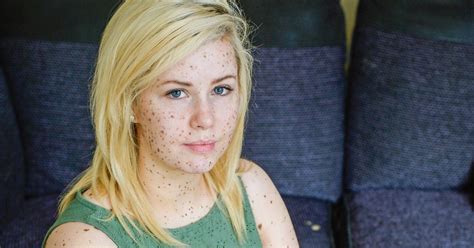 Mum Branded Dalmatian Girl Over Birthmarks Hits Back At Bullies In