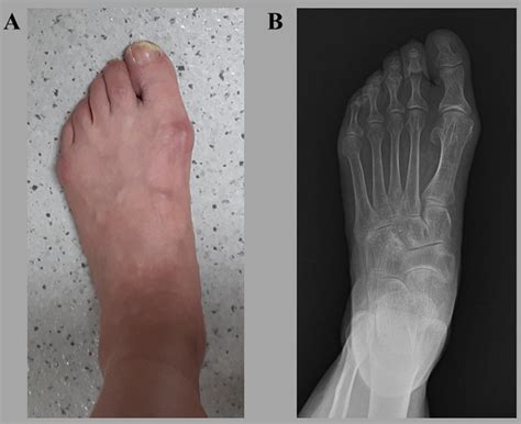 Foot Pressure Measurement Image The Foot Pressure Image Of A Normal