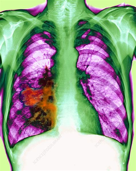 Lung Cancer X Ray Stock Image M1340572 Science Photo Library