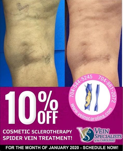 Say Goodbye To Spider Veins Before Spring Vein Specialists Of The