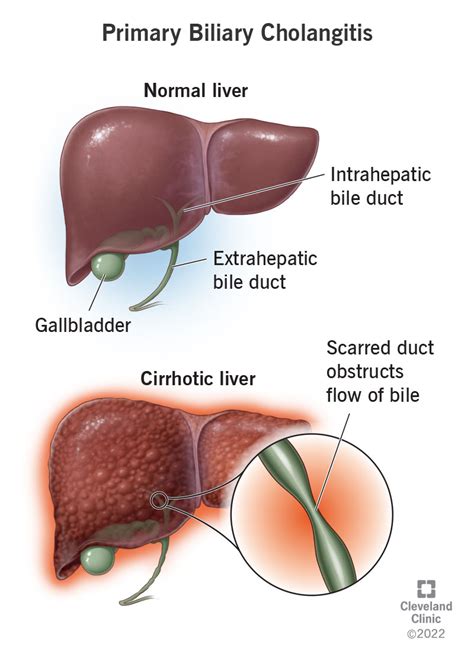 Primary Biliary Cholangitis What It Is Symptoms Treatment