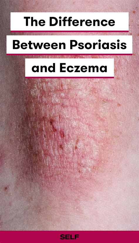 Udin 33 Early Stage Eczema Psoriasis