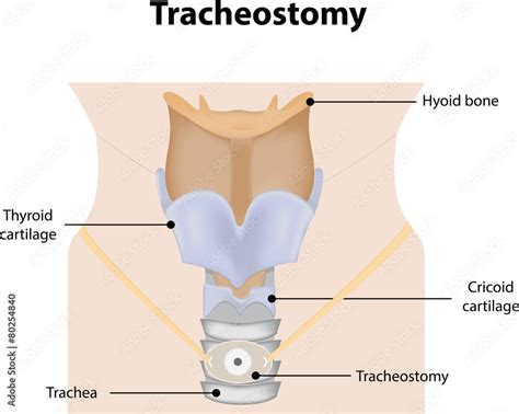 Tracheostomy Labeled Diagram Stock Illustration Adobe Stock