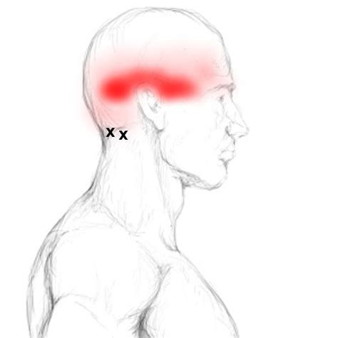 Suboccipital Muscles Pain And Trigger Points