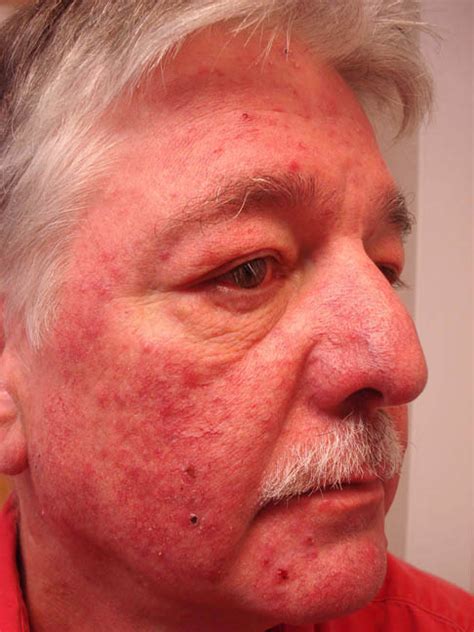 Virtual Grand Rounds In Dermatology 20 Red Face X Two