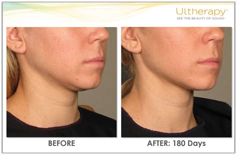 Ultherapy Results Under The Chin Ultherapy Underchinlift