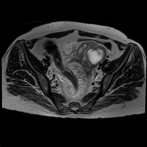 Bilateral Tubo Ovarian Abscesses Image Radiopaedia Org