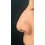Non Surgical Rhinoplasty In London  Nose Lift Dr Dray Aesthetic Doctor