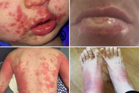 Skin Rashes Are The Only Symptom For 1 In 5 Covid Patients Docs Warn