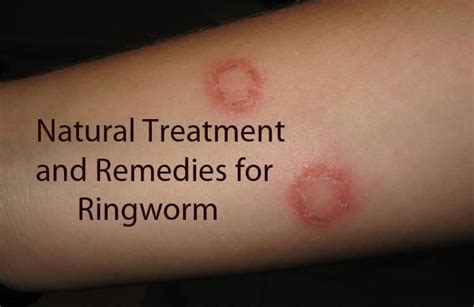 15 Effective And Useful Home Remedies To Get Rid Of Ringworm