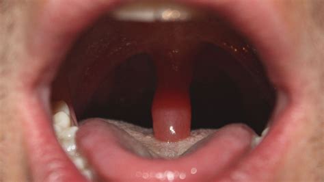 What Happens If You Have Your Uvula Removed