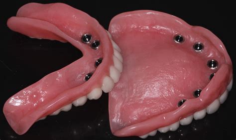 Glidewell Inclusive Mini Dental Implant Dentures | Denture implants