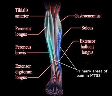 Medial Tibial Stress Syndrome Article Statpearls