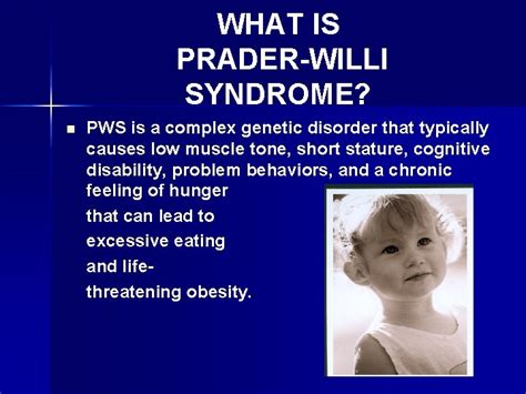 Prader Willi Syndrome Symptoms Causes Diagnosis Treatment Sexiz Pix
